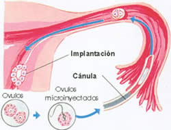 Microinyección intracitoplasmática de espermatozoides (ICSI)