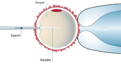 Fertilización In Vitro