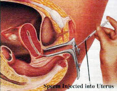 Inseminación Intrauterina