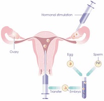 Transferencia Intrafalopiana de Gametos