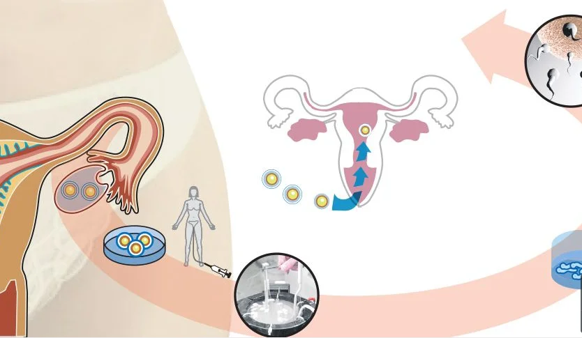 Vitrificación de óvulos